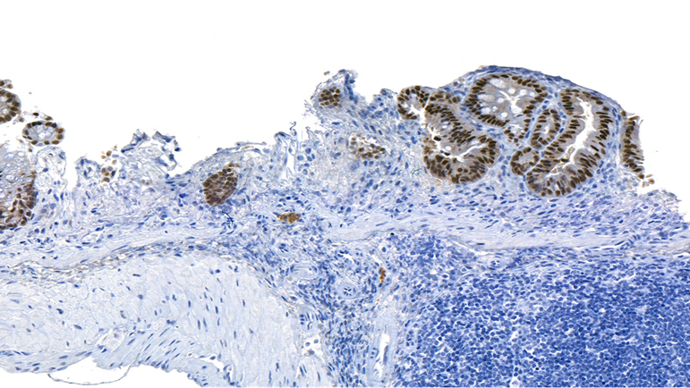 IHC_CDX2 / Colitis