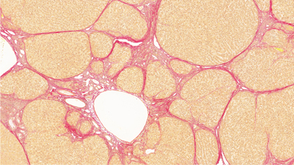 Fibrosis image