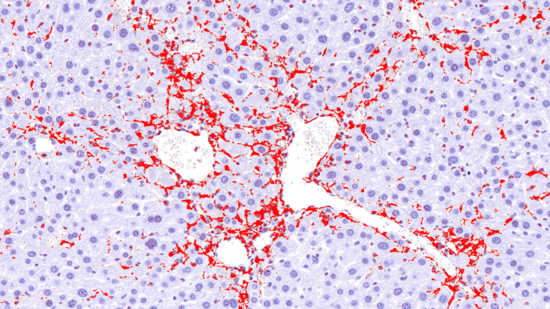 Liver fibrosis