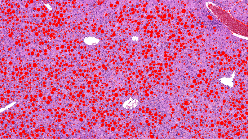 Liver Steatosis