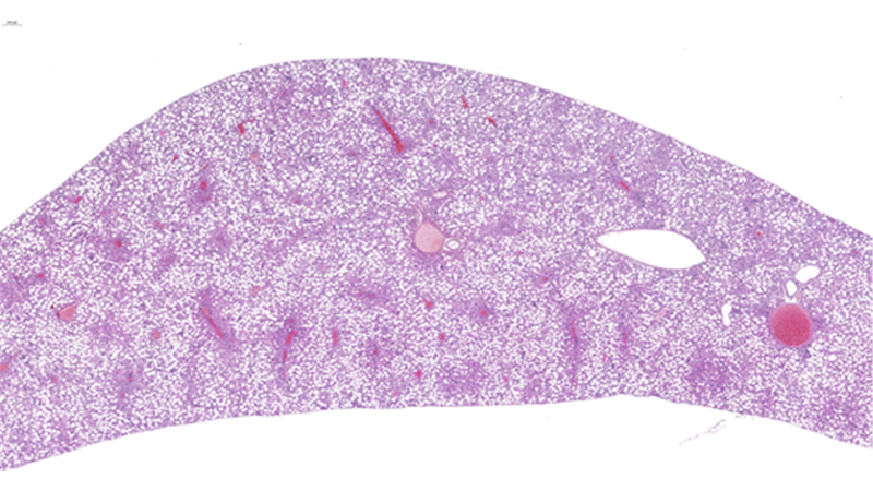 Fatty liver / Low Magnification