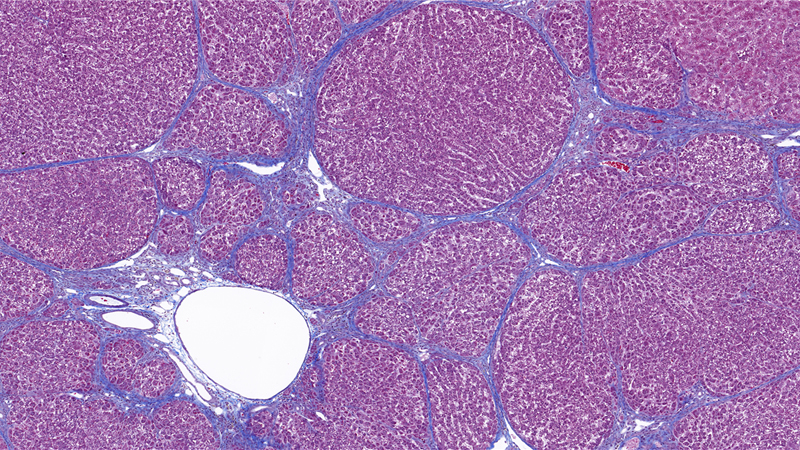 Liver cirrhosis