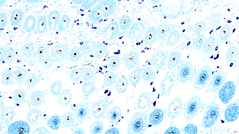 Atopic dermatitis